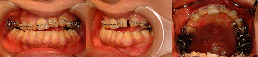 口唇口蓋裂の治療例　左側唇顎口蓋裂に起因する顔面非対称を呈する骨格性下顎前突　顎裂部骨移植直前　口腔内　正面＋左側＋上顎咬合面